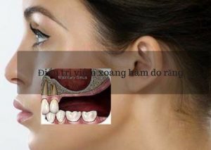 Biểu hiện viêm xoang hàm do răng