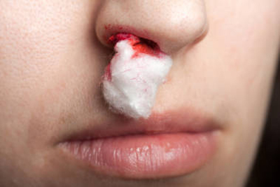 Chảy máu mũi do viêm xoang có nguy hiểm không ?
