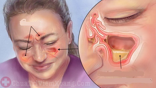 Viêm đa xoang là viêm nhiều xoang cùng một lúc