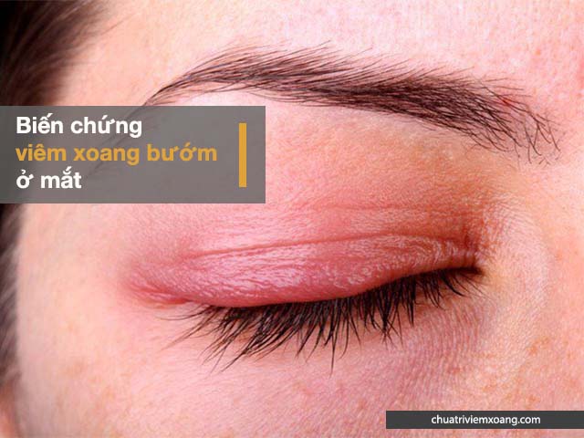 Biến chứng viêm xoang bướm ở mắt
