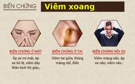 Lương y Đỗ Minh Tuấn chỉ ra 6 biến chứng nguy hiểm của viêm xoang